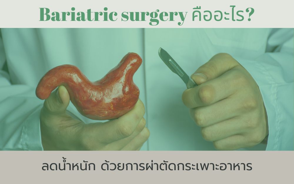 Bariatric surgery คืออะไร? ลดน้ำหนัก ด้วยการผ่าตัดกระเพาะอาหาร